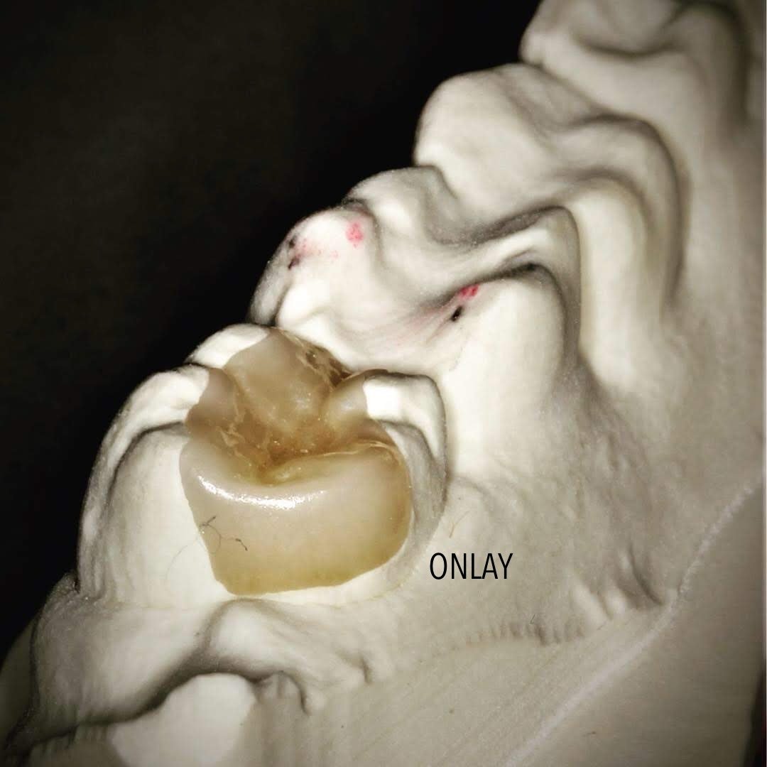 Desson Inlay Inlays/Onlays – Dentist Poquoson